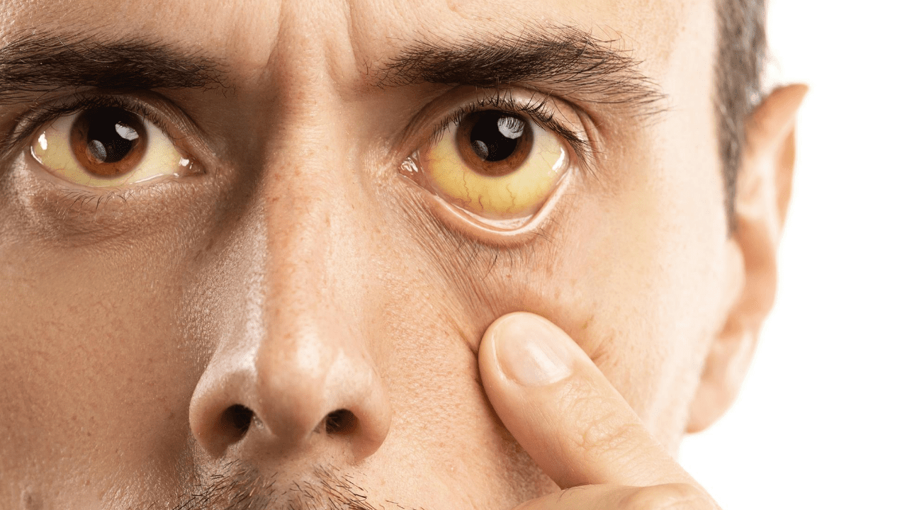 Jaundice is the yellowing of skin, white part of the eyes and an increase in the mucus